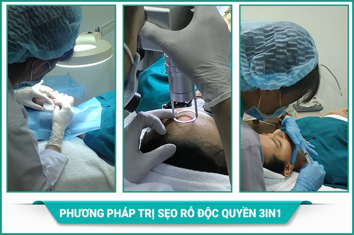 công nghệ điều trị sẹo rỗ mới nhất năm 2019 phương pháp 3in1