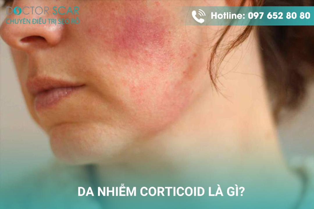 Da bị nhiễm corticoid có nên lăn kim không