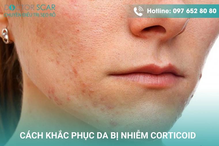 Cách khắc phục làn da bị nhiễm corticoid