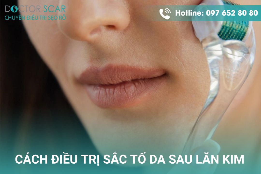 Cách điều trị da bị tăng sắc tố sau lăn kim điều trị sẹo rỗ