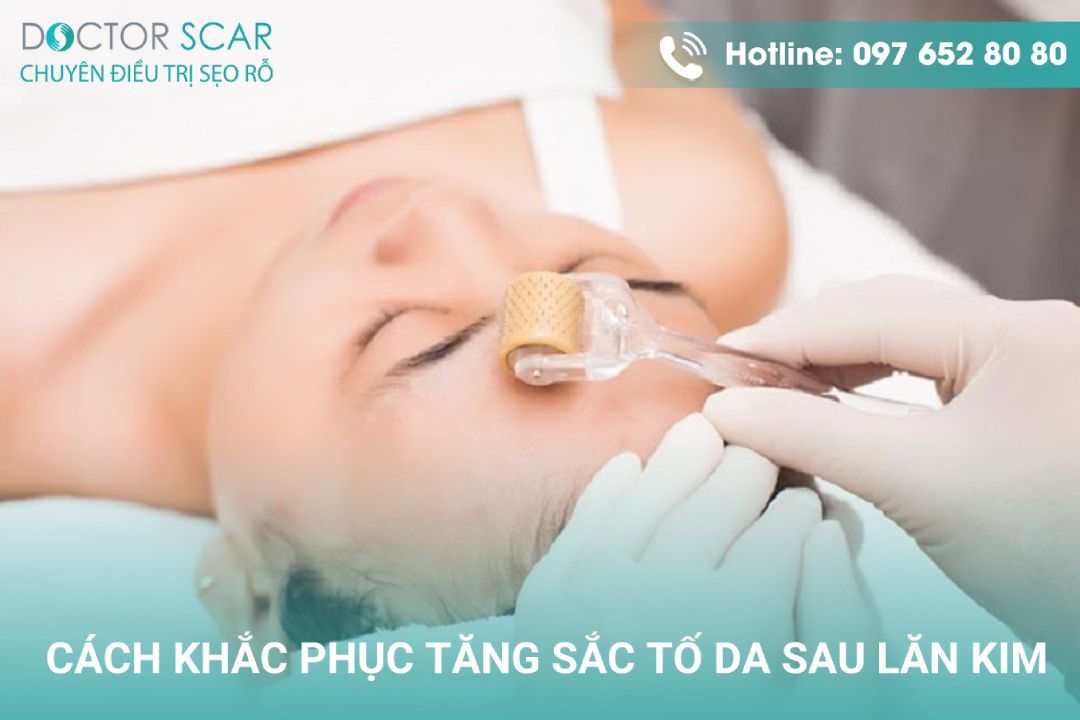 Cách khắc phục da bị tăng sắc tố sau lăn kim điều trị sẹo rỗ