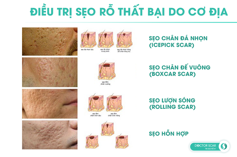 điều trị sẹo rỗ thất bại do cơ địa