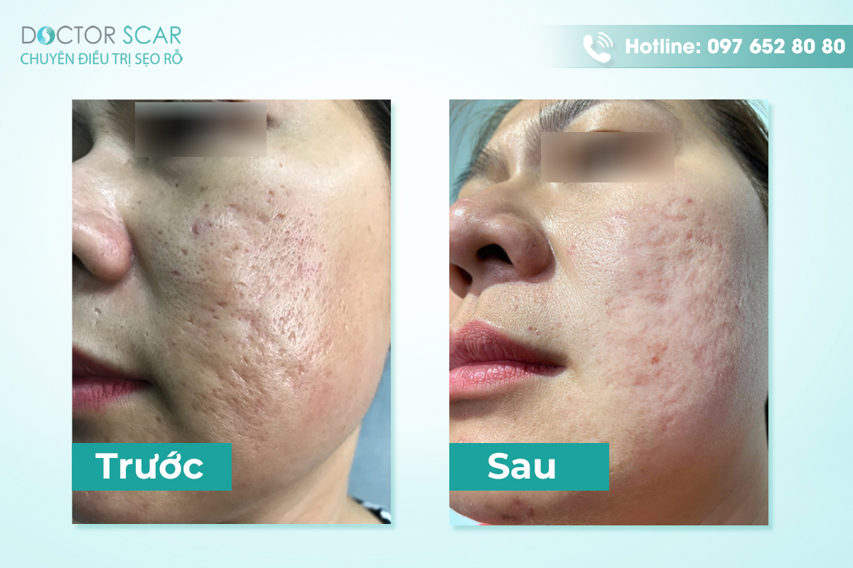 Hình ảnh trước và sau xóa sẹo tại Doctor Scar