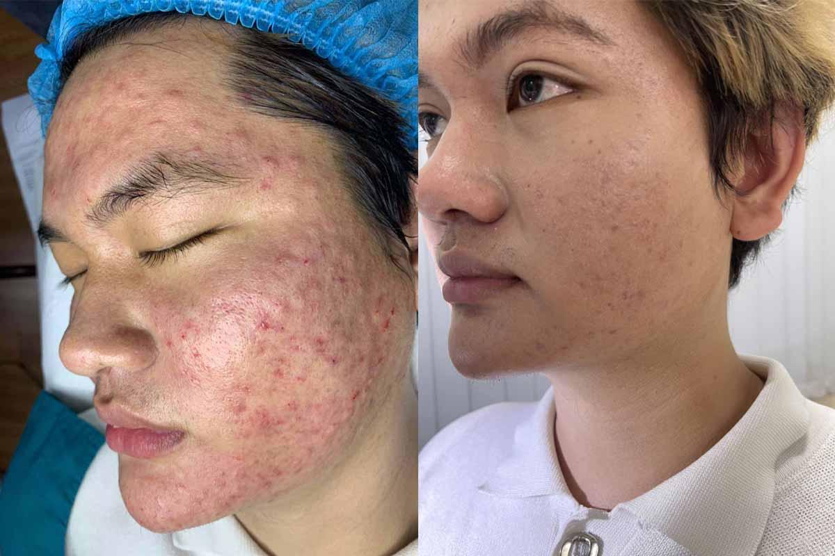 Hình ảnh khách hàng 2: da mặt sau khi tiêm meso, nếp nhăn được giảm thiểu, da trở nên căng mịn và trẻ trung