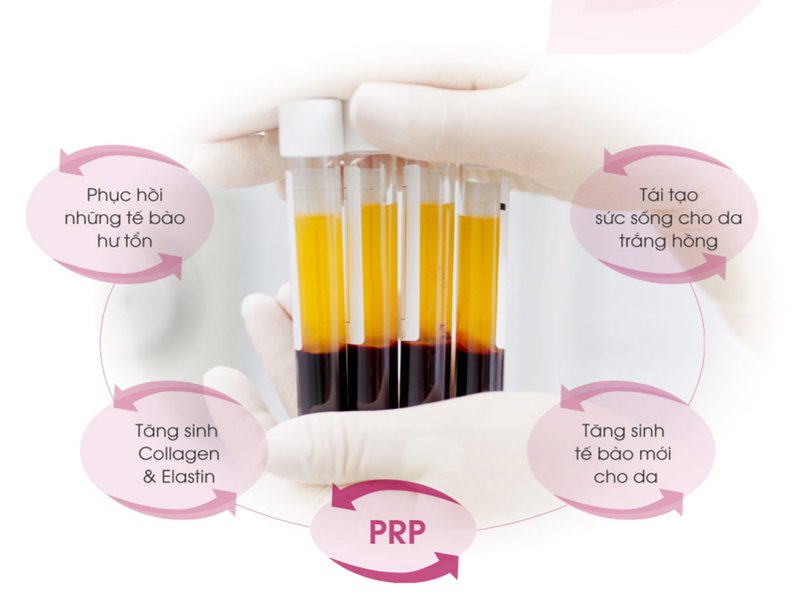 trị sẹo bằng prp