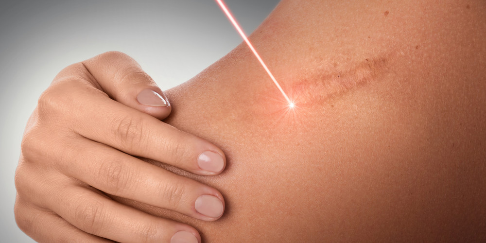 chi phí trị sẹo lồi bằng laser