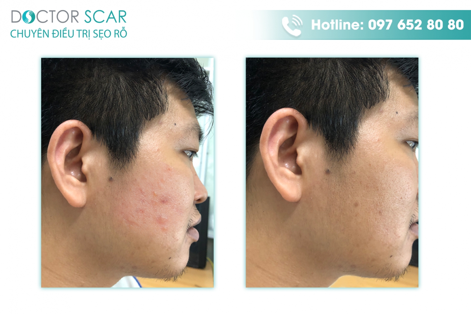 Khách hàng lấy nhân mụn thành công tại Doctor Scar