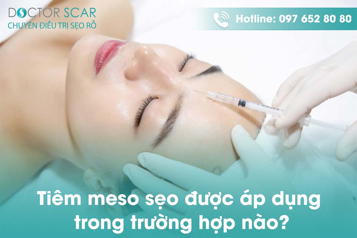Tiêm meso được áp dụng khi nào