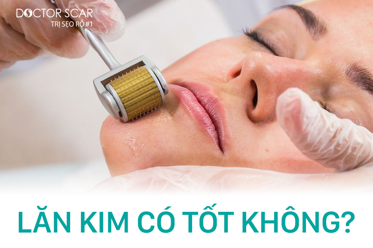 Lăn kim có tốt không?