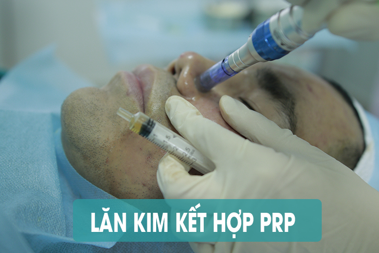 lan-kim-ket-hop-prp-tri-seo-ro