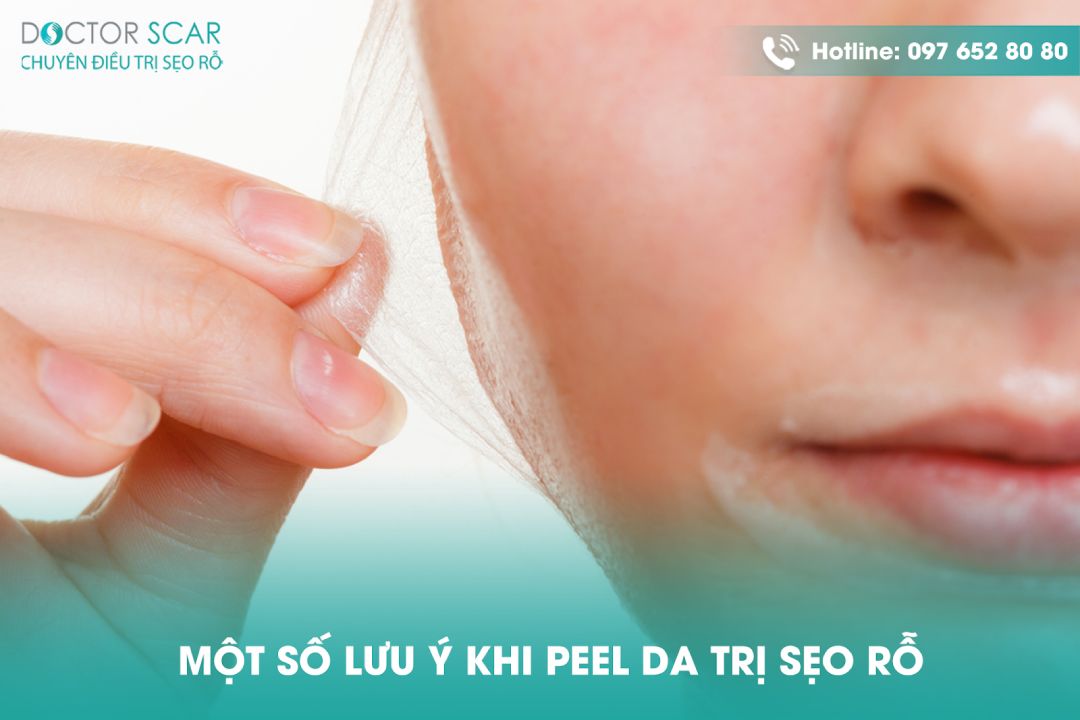 Peel da trị sẹo rỗ