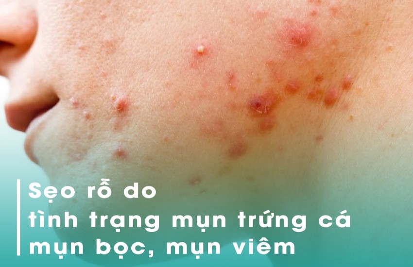 sẹo rỗ/lõm do mụn trứng cá gây lên