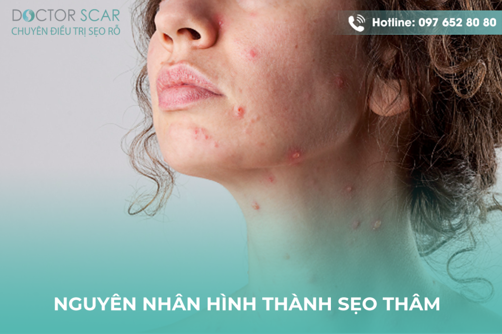 Nguyên nhân hình thành sẹo thâm