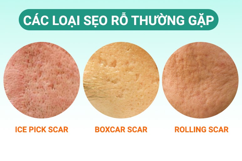 Phân loại các loại sẹo rỗ thường gặp như box scar, ice pick, rolling scar
