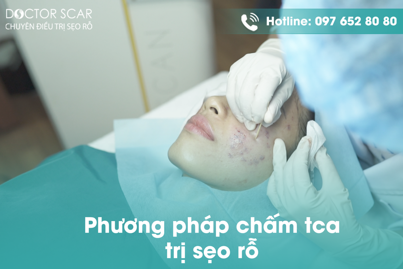 Phương pháp chấm tca trị sẹo rỗ chân đá nhọn lâu năm