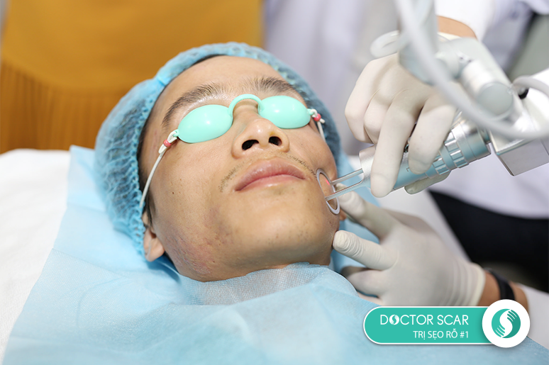 Laser Fractional CO2 hiện là phương pháp hiện đại và phổ biến trong điều trị lỗ chân lông to