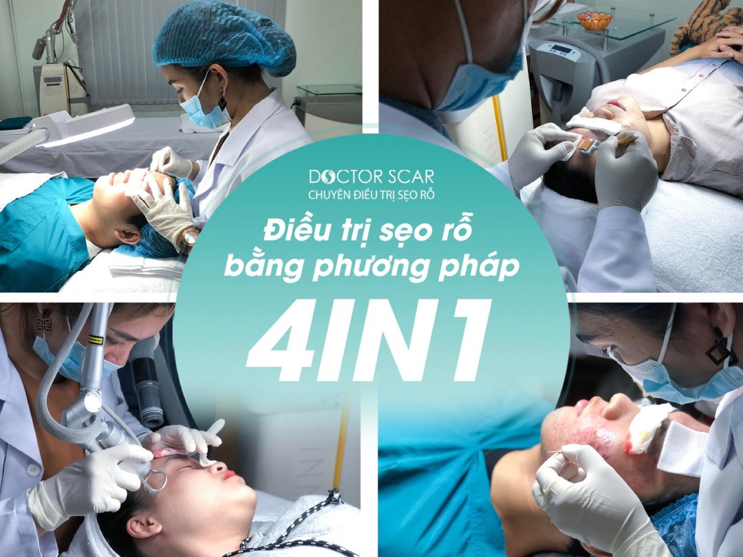 Phương pháp trị sẹo rỗ 4in1 cam kết không tái lõm làm đầy sẹo lên đến 80