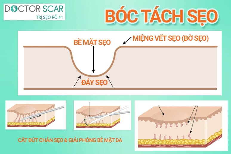 phương pháp điều trị sẹo rỗ bóc tách sẹo