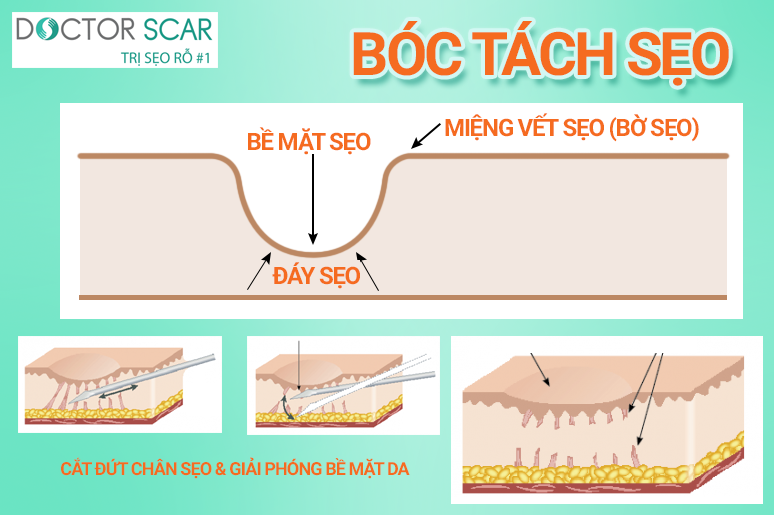 phương pháp điều trị sẹo rỗ bóc tách sẹo