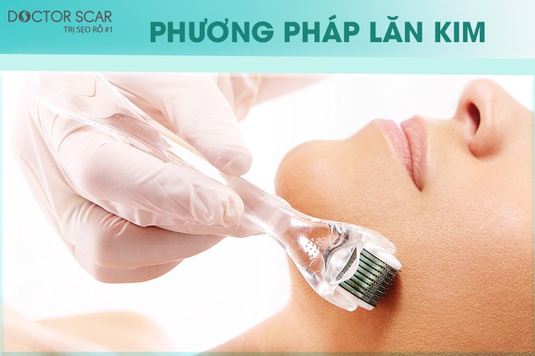 phương pháp lăn kim trị sẹo rỗ