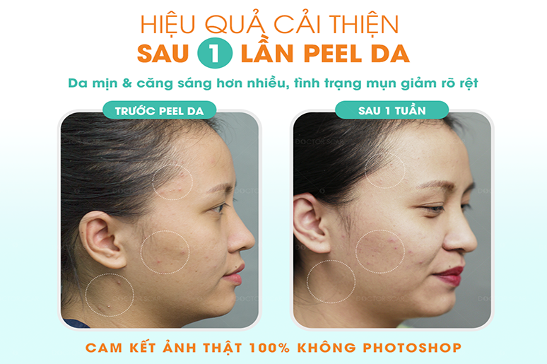 phuong-phap-peel-da-khien-mun-va-tham-phai-tranh-xa (2)