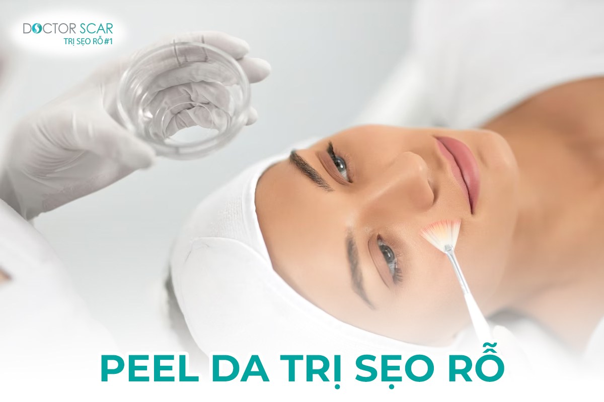 Phương pháp trị sẹo rỗ bằng peel da