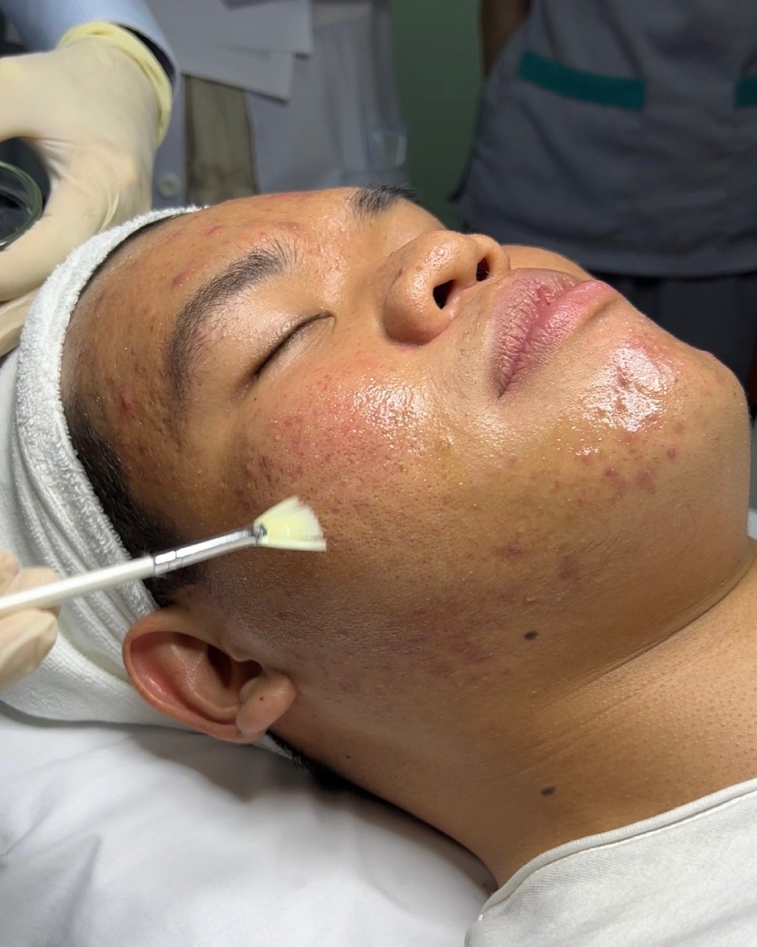 Phương pháp peel da trị sẹo rỗ