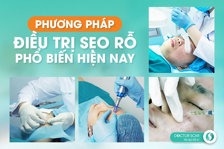 phương pháp trị sẹo rỗ hiệu quả hiện nay