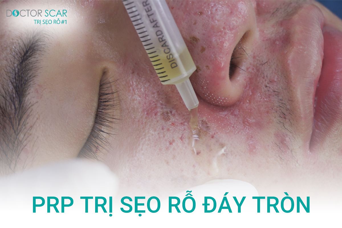 prp trị sẹo lõm đáy tròn