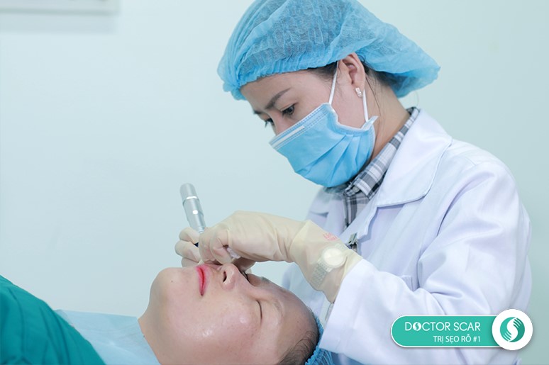 quy trình lăn kim siêu vi điểm Doctor Scar