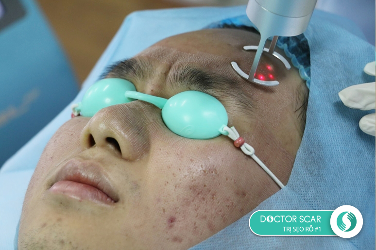 quy-trinh-tri-seo-ro-bang-laser