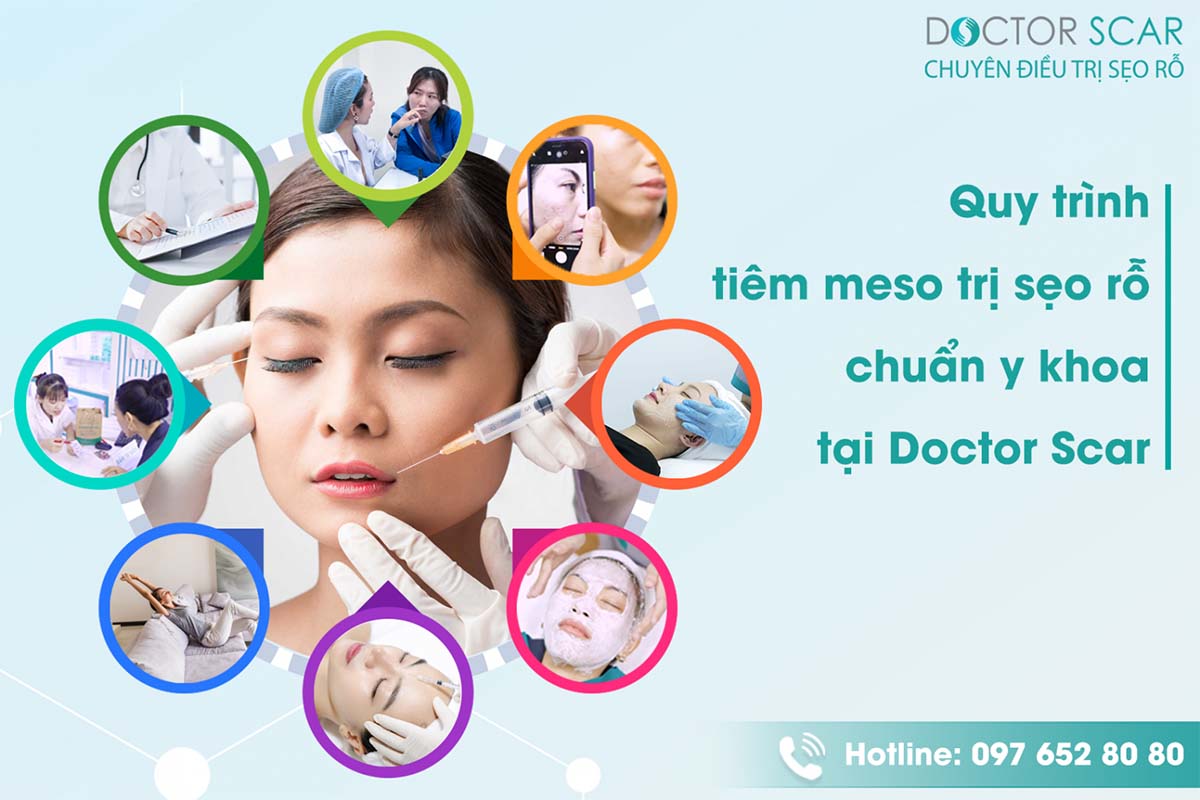 quy trình tiêm meso trị sẹo rỗ chuẩn y khoa