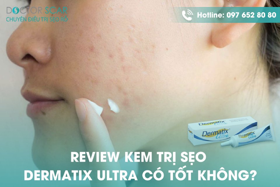 Review kem trị sẹo dermatix ultra