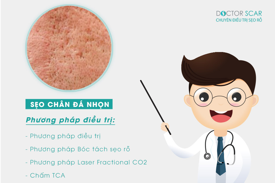 sẹo chân đá nhọn ice pick scar