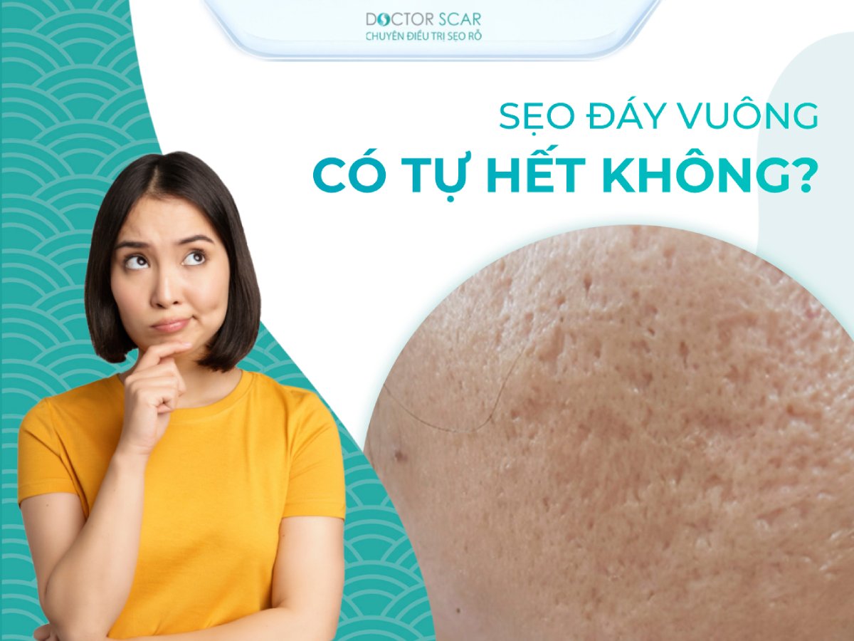 Sẹo rỗ đáy vuông có tự khỏi không