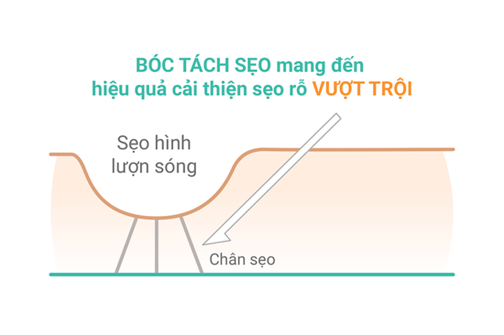 Bóc tách sẹo mang lại hiệu quả cải thiện vượt trội trong điều trị sẹo rỗ lâu năm