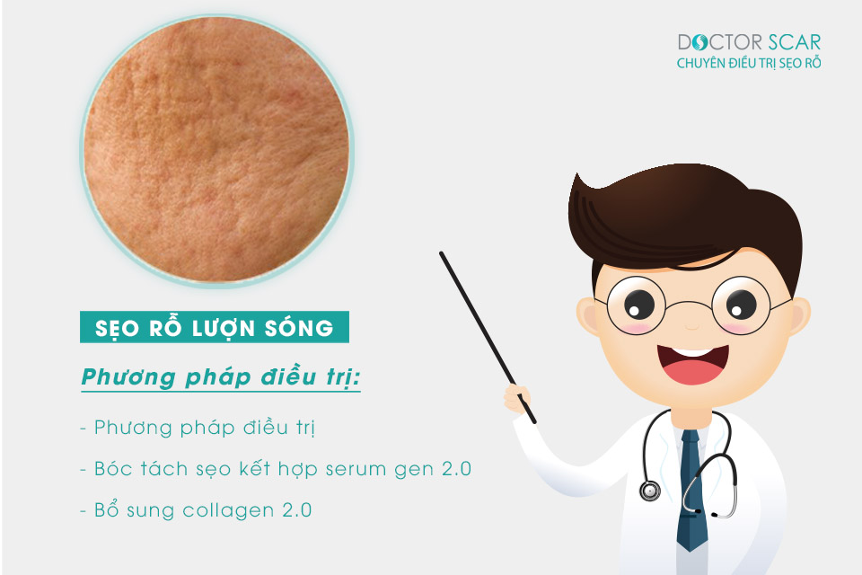 Sẹo rỗ hình lượn sóng Rolling Scar