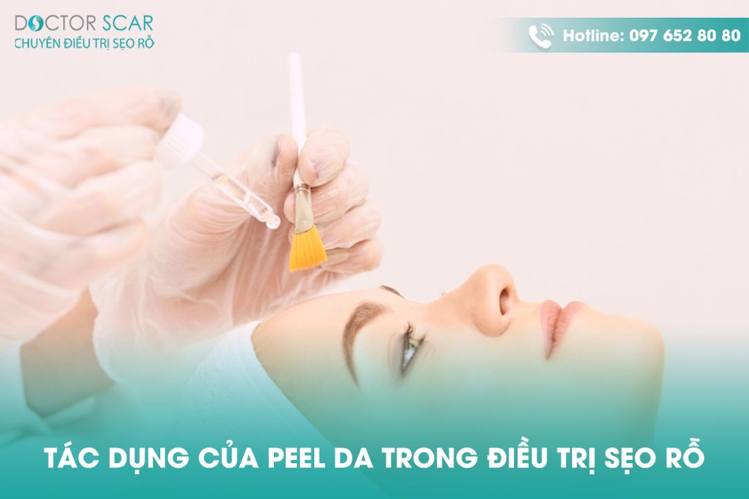 Peel da trị sẹo rỗ có tốt không?