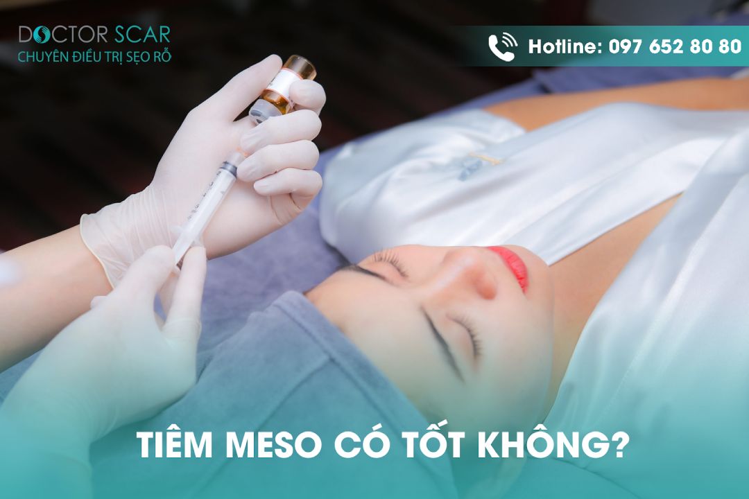 Tiêm mesotherapy có tốt không?