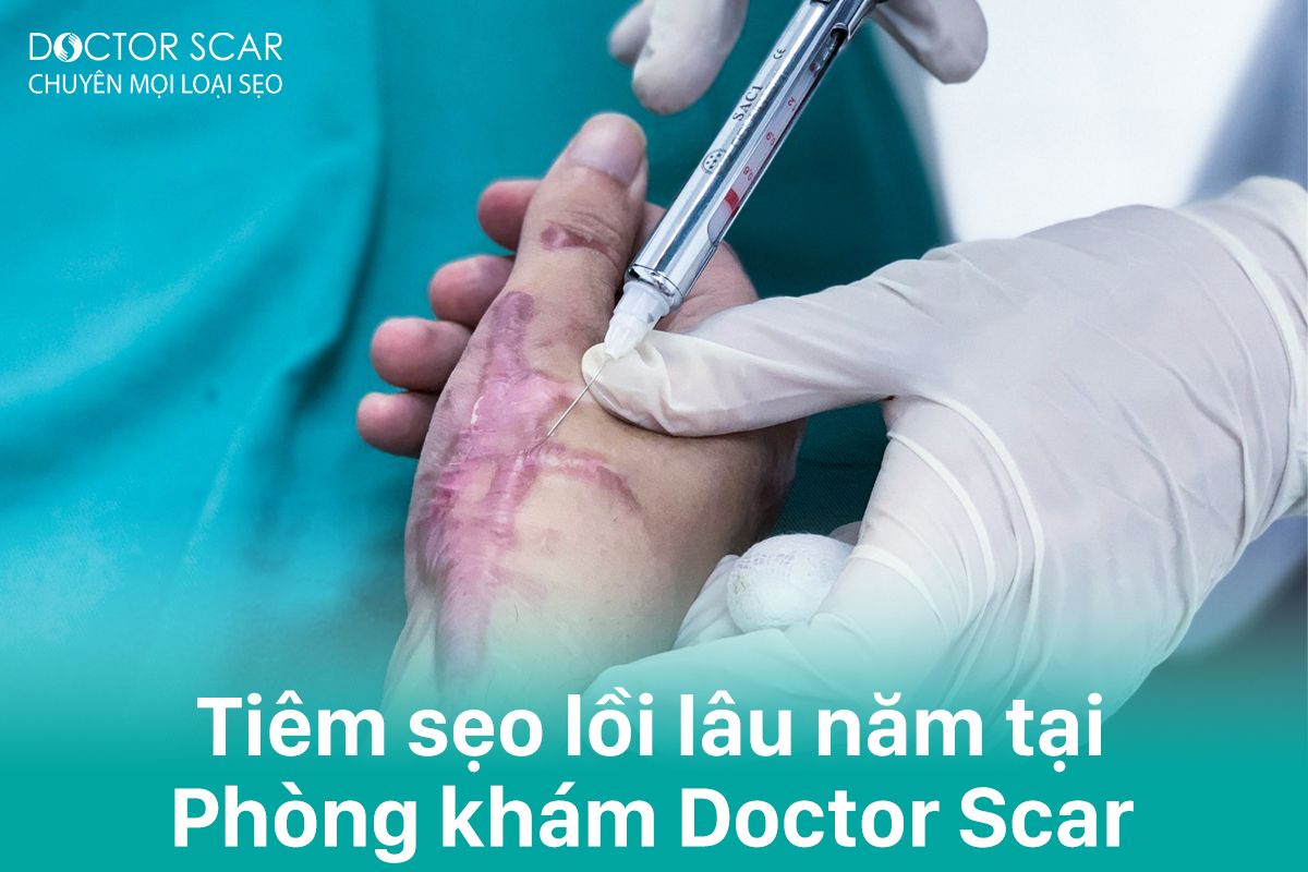 tiêm sẹo lồi lâu năm tại doctor scar