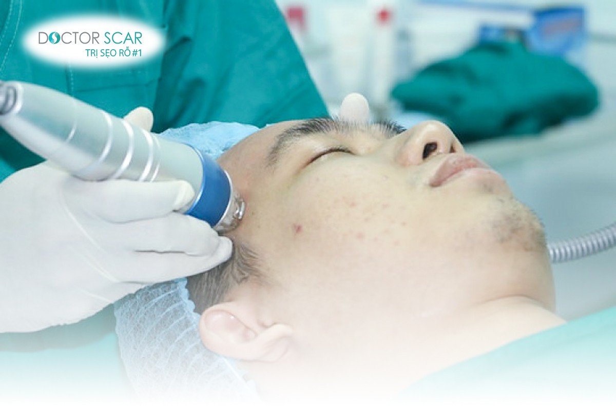 Trị sẹo lõm bằng laser Fractional Co2