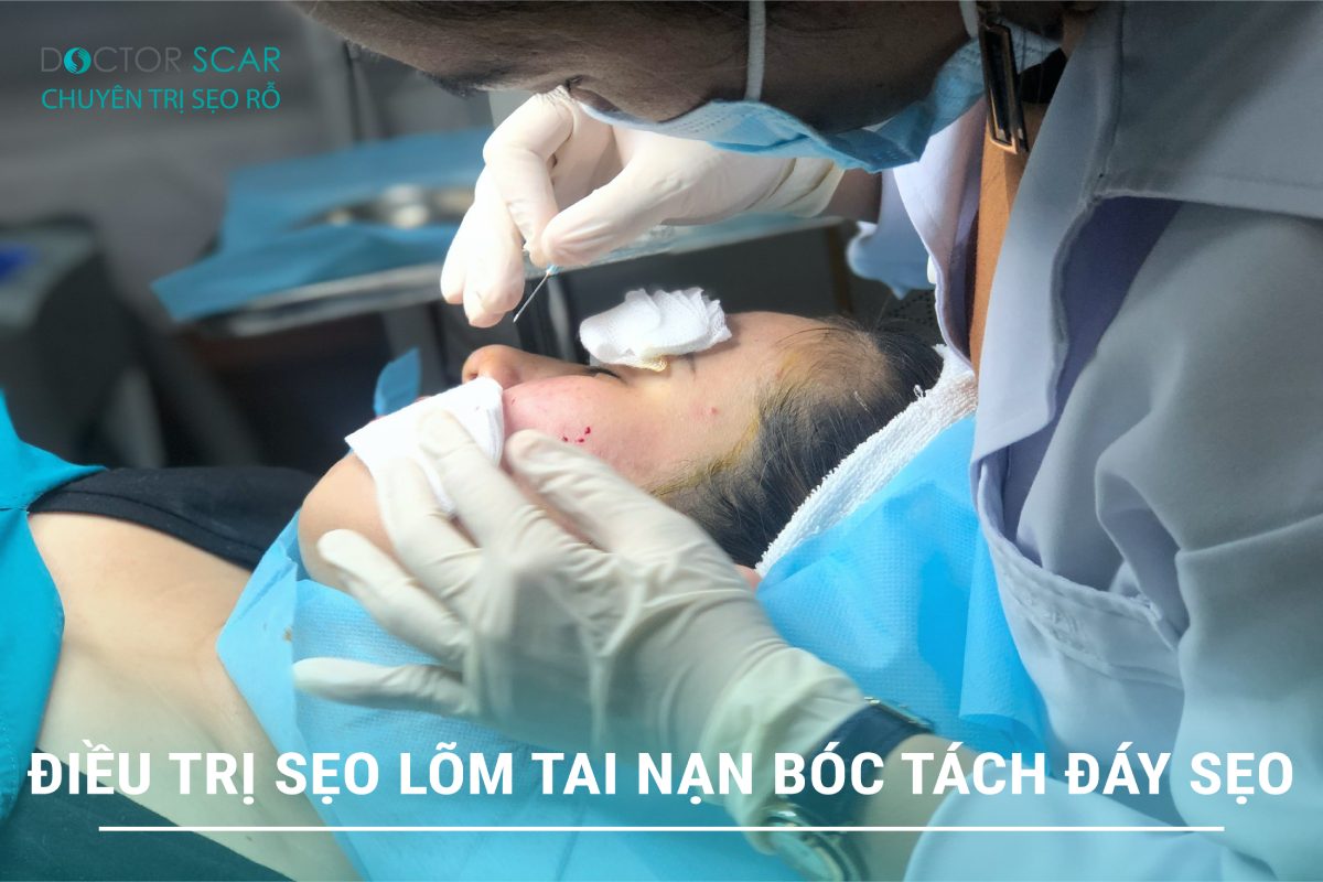 Bóc tách sẹo trị sẹo lõm tai nạn