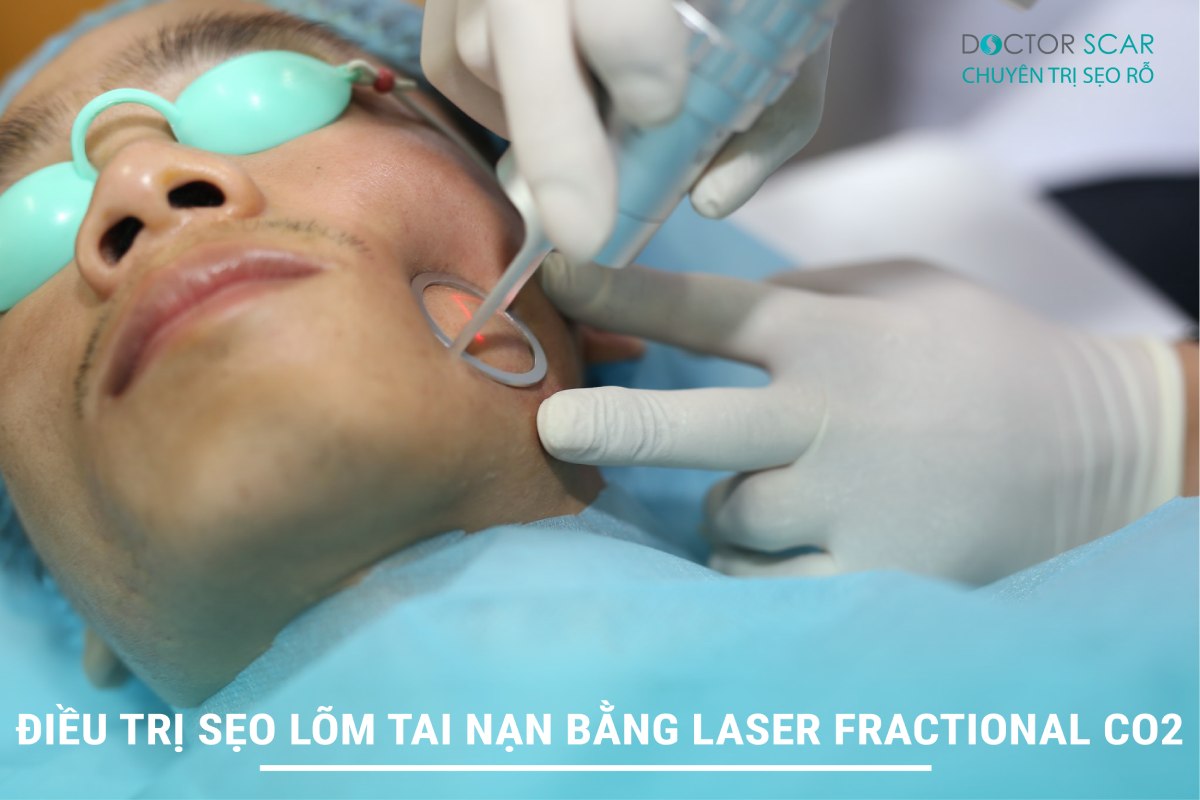 Trị sẹo lõm tai nạn bằng laser