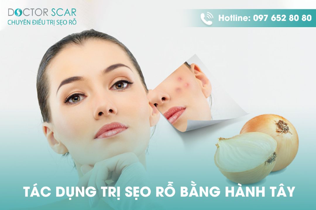 Cách trị sẹo rỗ bằng hành tây