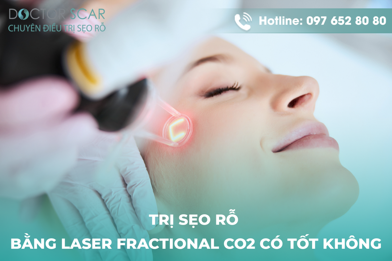 Hình ảnh khách hàng điều trị sẹo rỗ bằng laser fractional co2