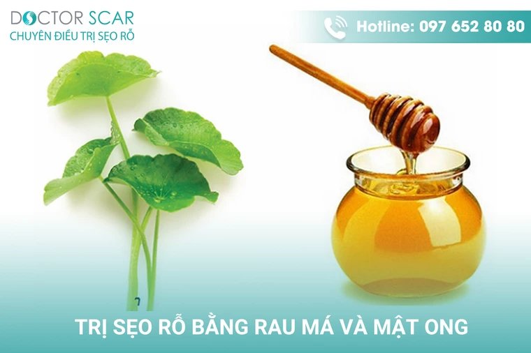 Hướng dẫn cách trị sẹo rỗ bằng rau má và mật ong