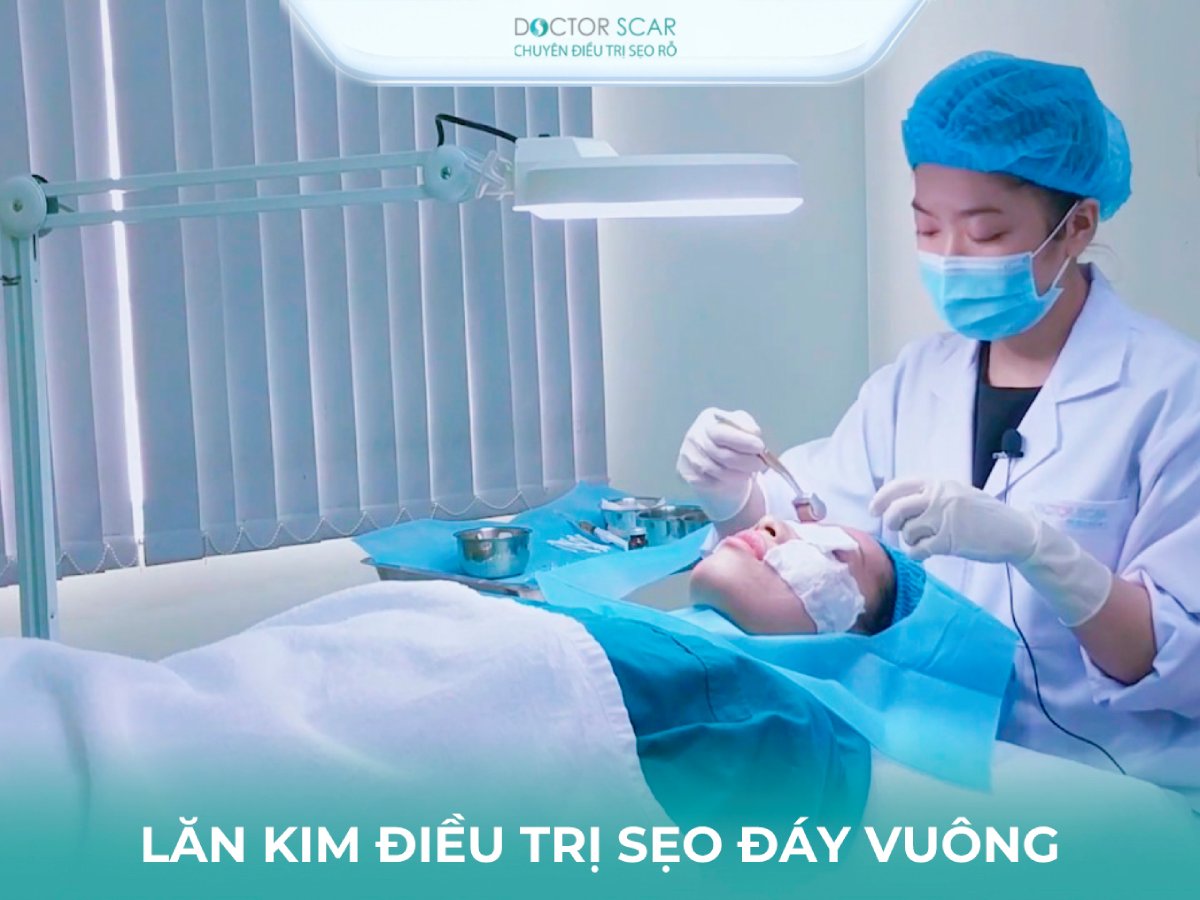 Trị sẹo rỗ đáy vuông bằng lăn kim