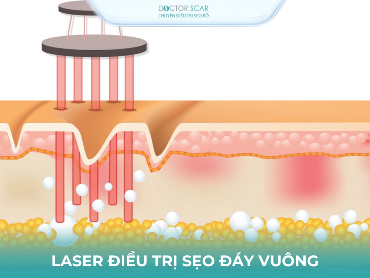 Trị sẹo rỗ đáy vuông bằng laser co2