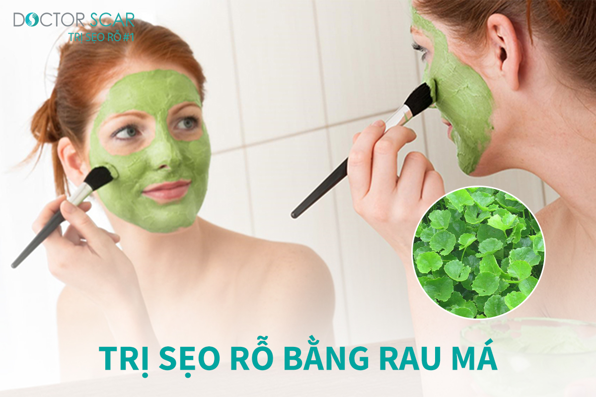 Trị sẹo rỗ tại nhà bằng rau má