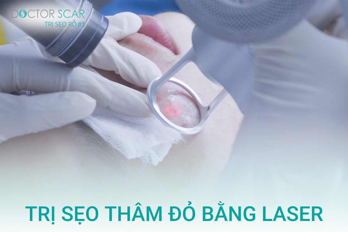 Trị sẹo thâm đỏ sau tai nạn bằng laser fractional co2